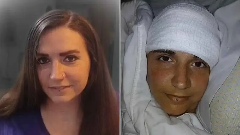 شريحة "نيورالينك" تعيد حلم الحركة والتواصل لامرأة مشلولة (فيديو)