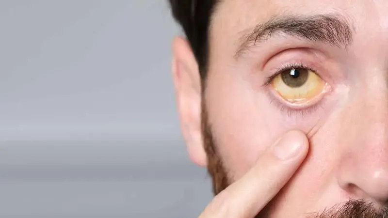 "مركّب اليرقان".. سلاح طبيعي ضد الملاريا