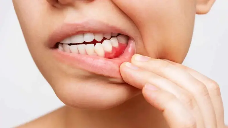 نزيف اللثة قد يؤدي إلى نوبة قلبية في الثلاثين